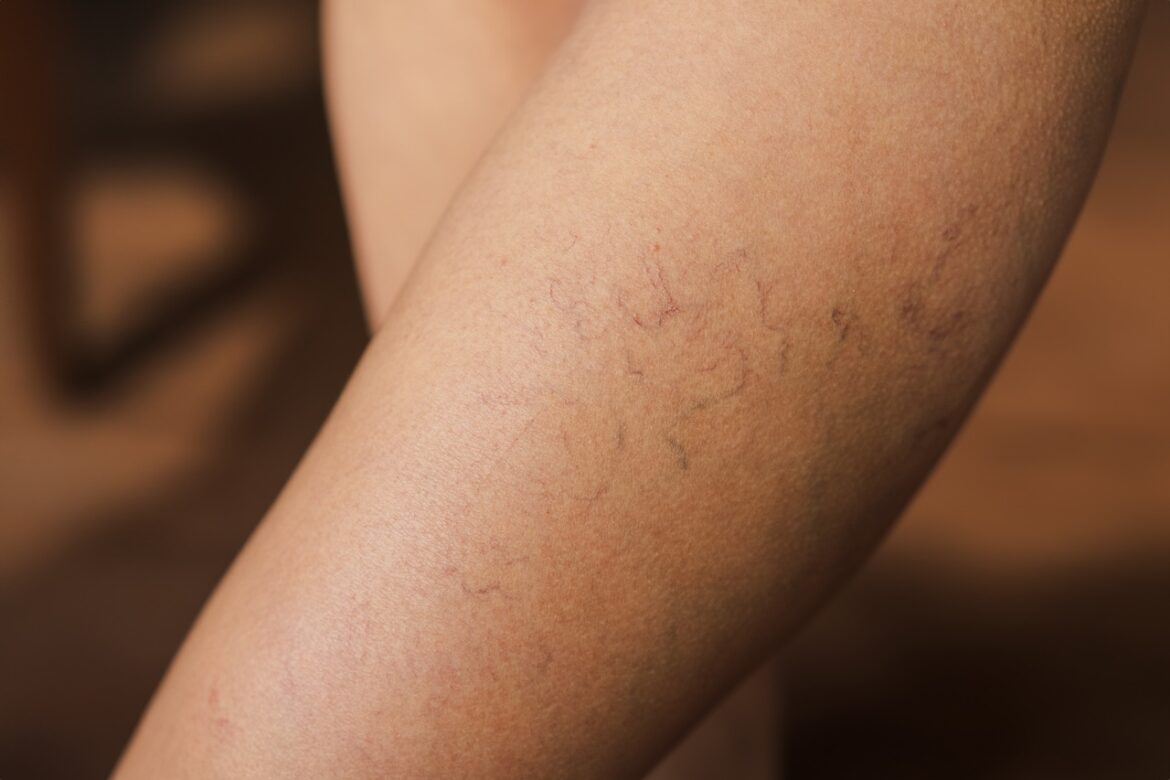 How to Get Rid of Spider Veins with Laser Therapy