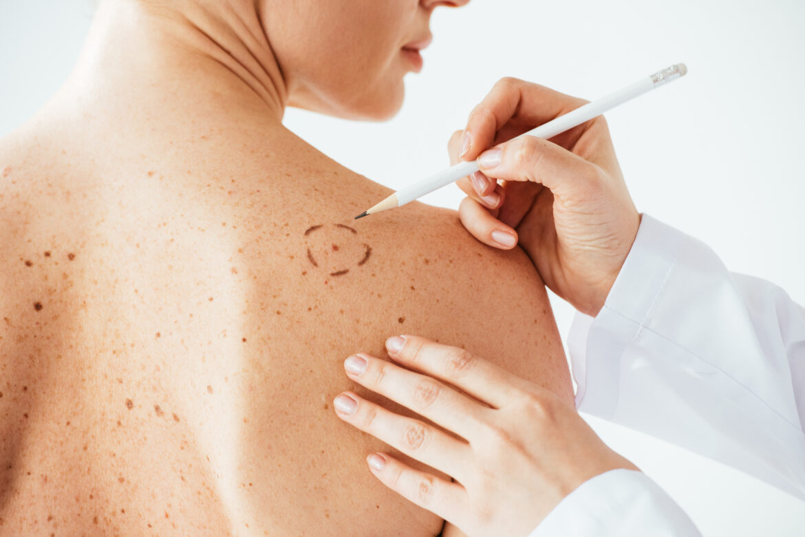 What Makes Melanoma More Dangerous Than Other Skin Cancers?
