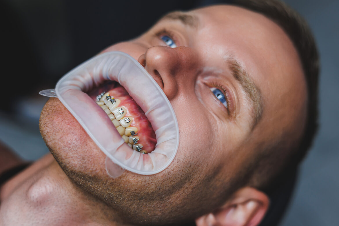 How Adult Braces Can Improve Speech and Pronunciation